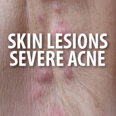 The Doctors helped a patient named Brian who suffered from extreme acne and skin lesions on his body, a condition called Hidradenitis Suppurativa.